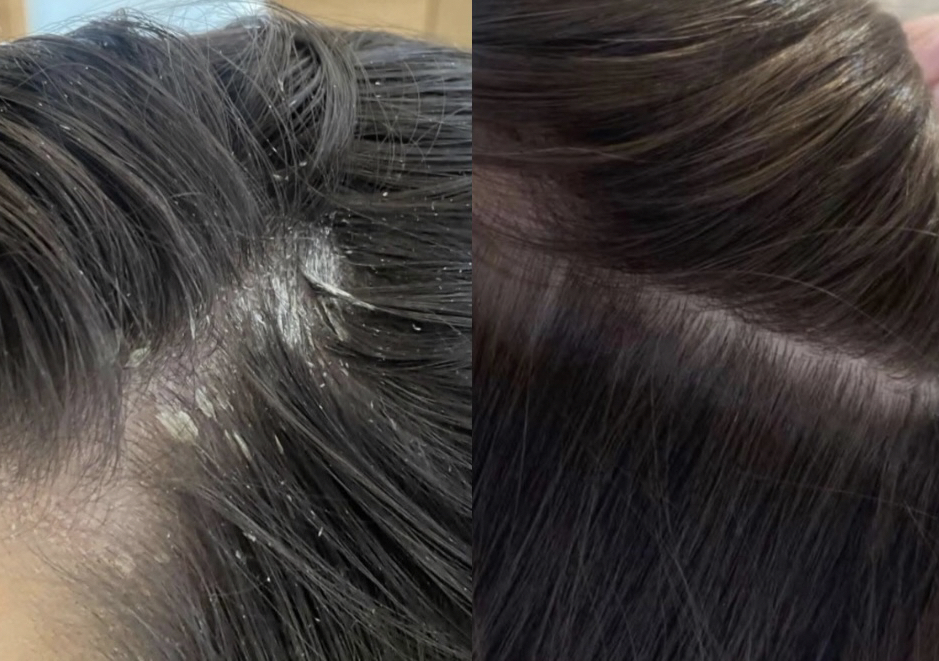 K&L Signature Scalp Therapy Head Spa Clinical Treatment