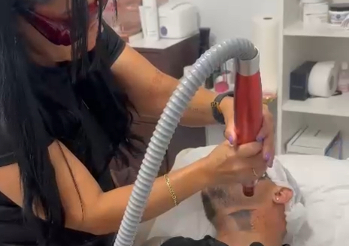 (Hollywood peel)  + Facial