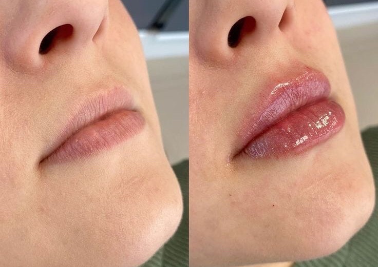 Needle Less Lip Fill 2 Ampoules