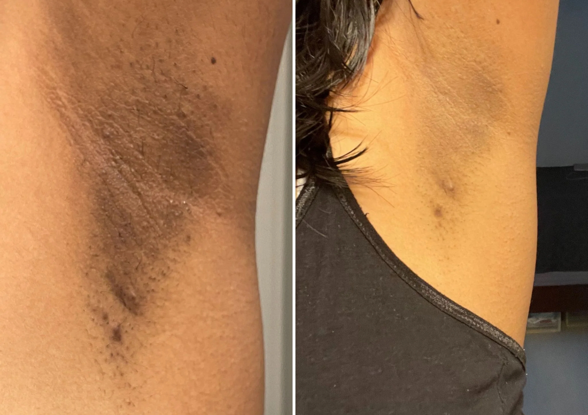 Intimate Radiance Treatment