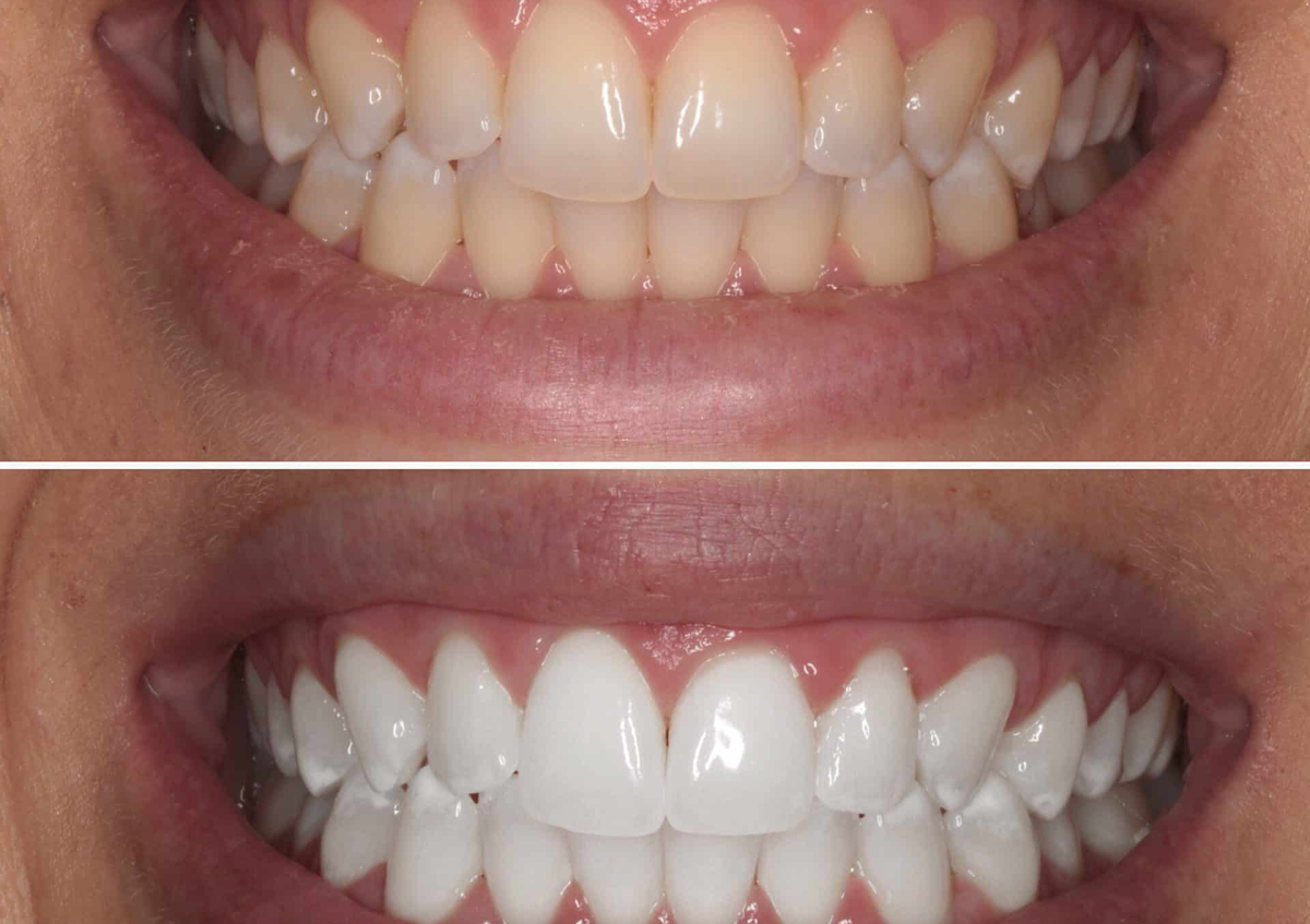 1 Hour Glow Whitening Treatment