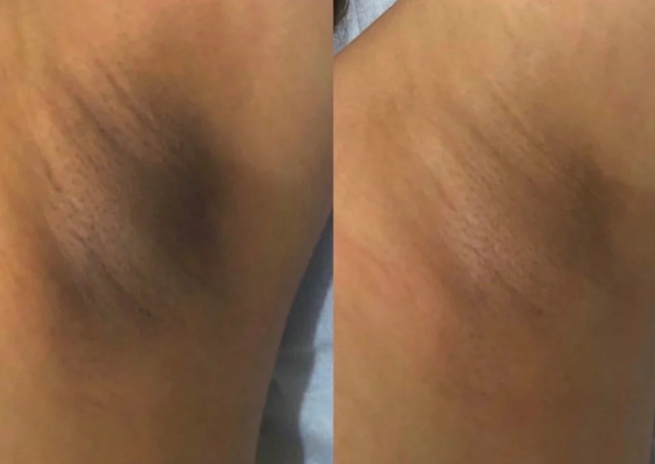 Intimate Skin Bleaching (Per Area: Underarms, Bikini, or Buttocks)