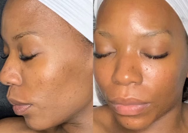 Diamond Glo Microdermabrasion