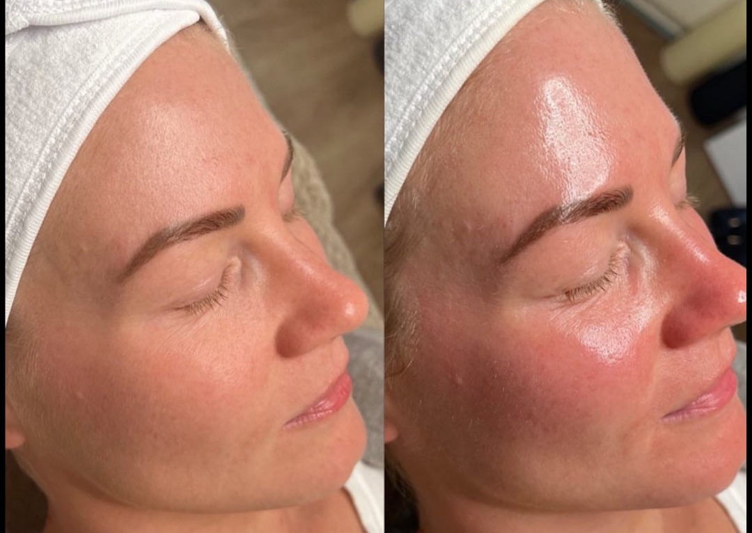 Bio Re Peel + Custom Facial