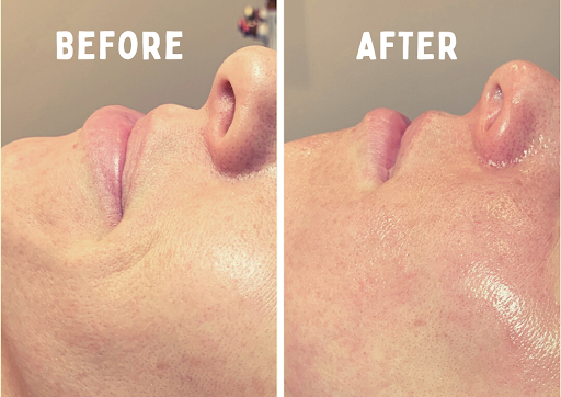 HydraFacial + Dermaplanning