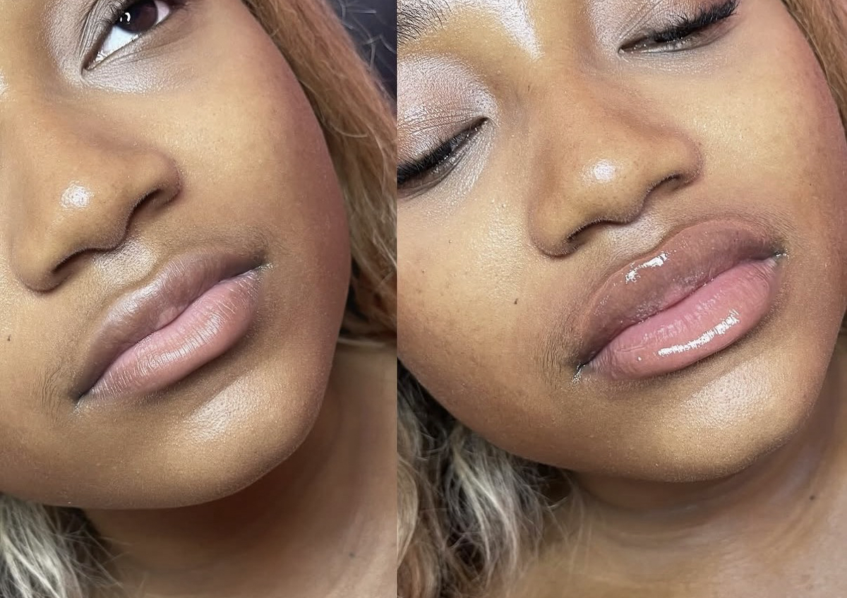 Needle less lip enhancement