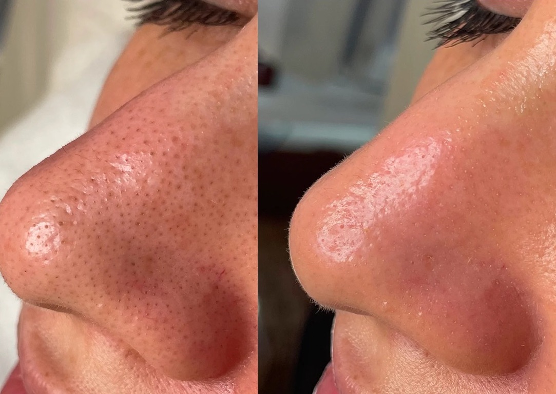 Glass Skin HydraFacial + Oxygen Therapy