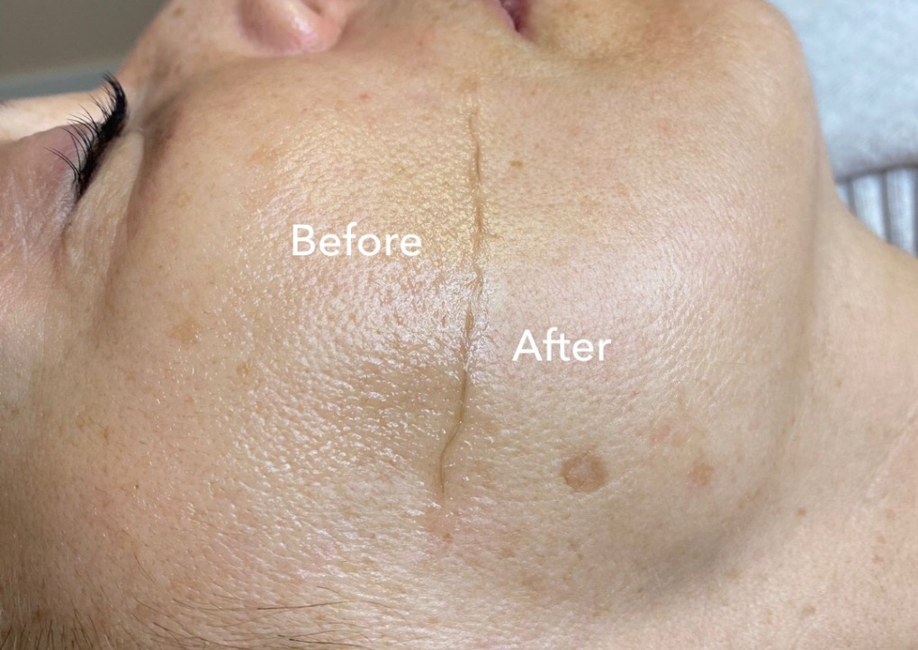 Dermaplanning + Chemical Peel