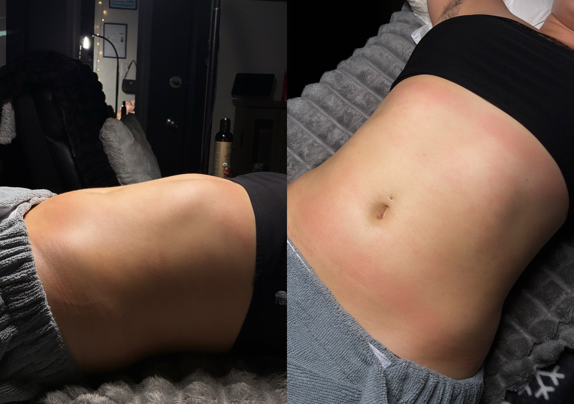 Half body lymphatic driange 