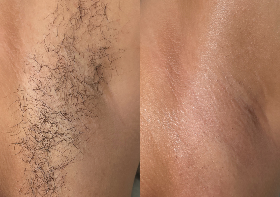 Underarms/bikini wax 