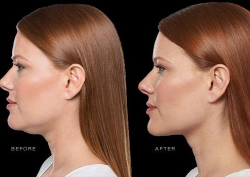 Kybella®