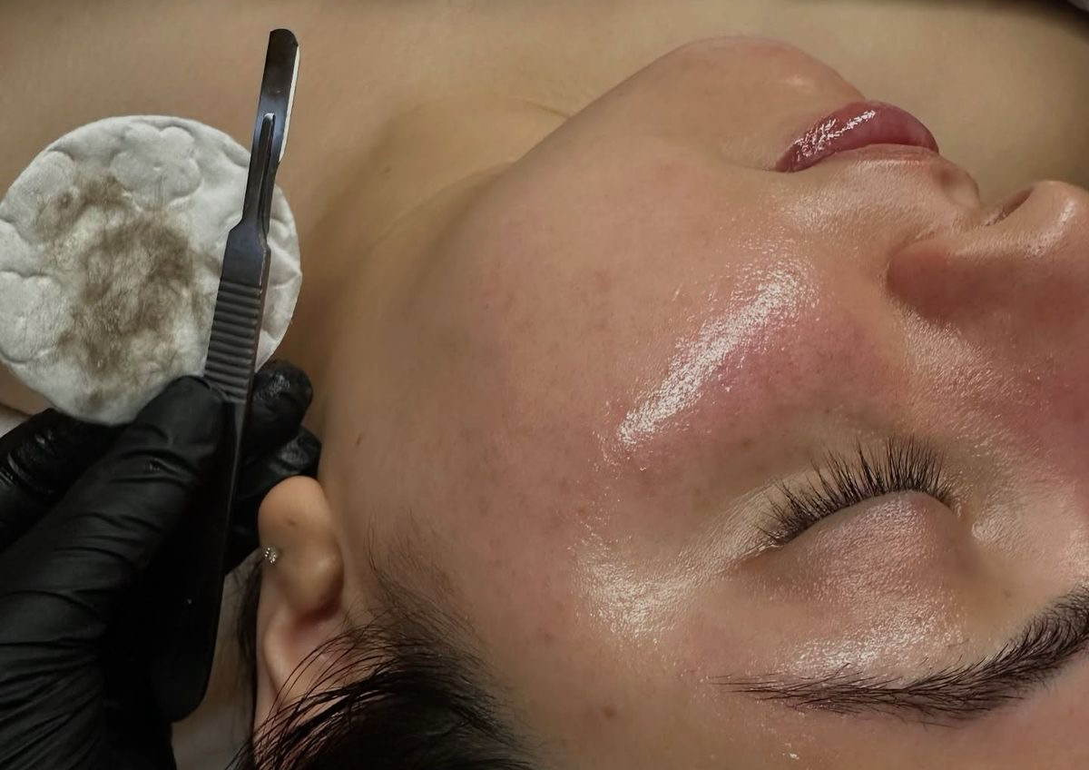 Dermaplaning