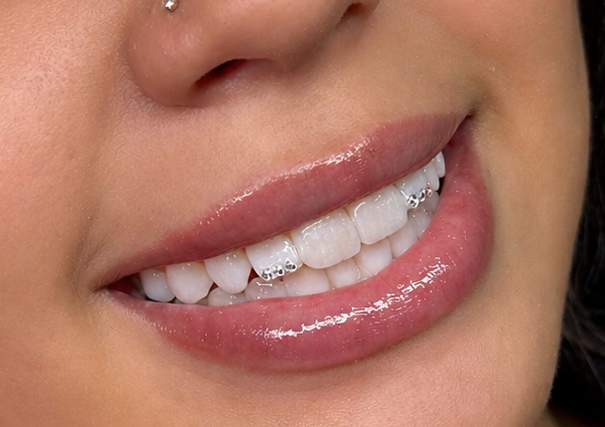 6x Swarovski tooth gem 