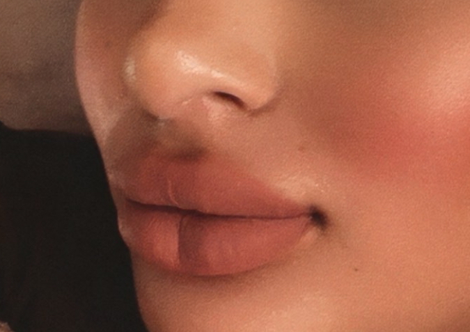Lip filler (hyaluronic acid)