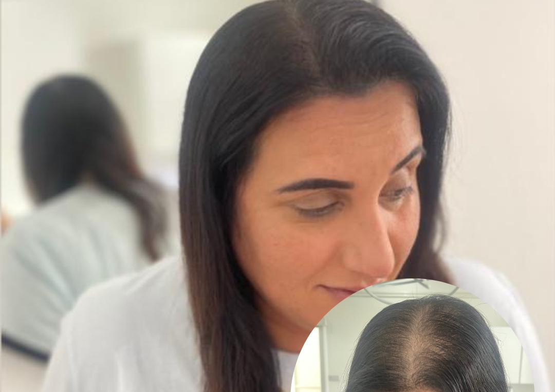 SMP (Scalp Micropigmentation) Density for Women