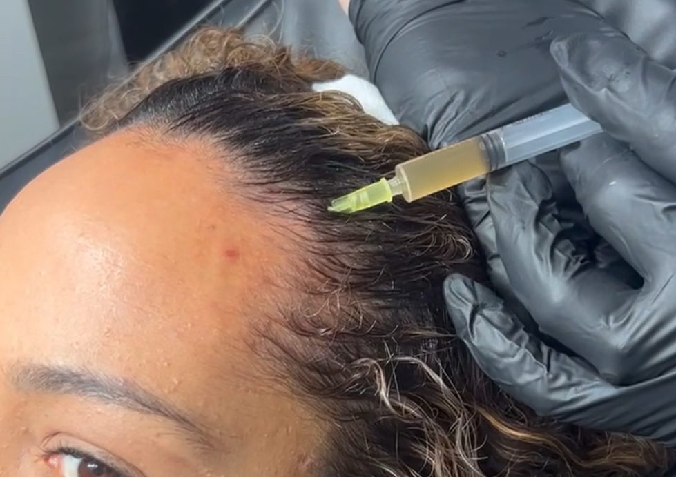 PRP (Platelet Rich Plasma)