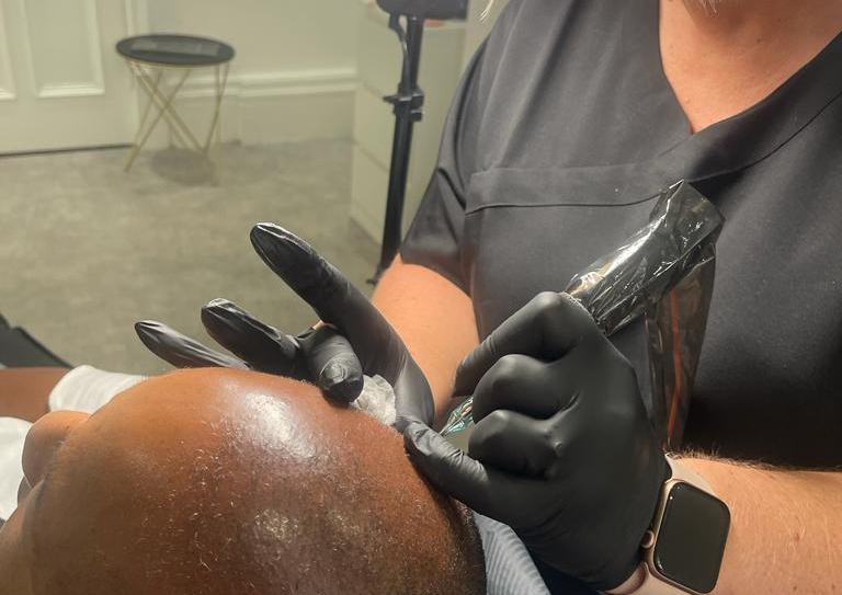 SMP (Scalp Micropigmentation)