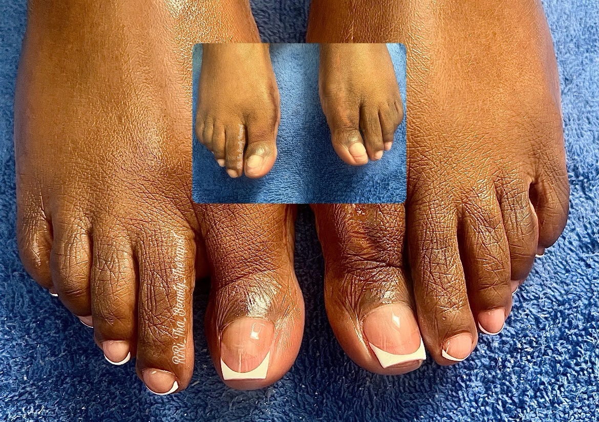 Toenail Reconstruction 