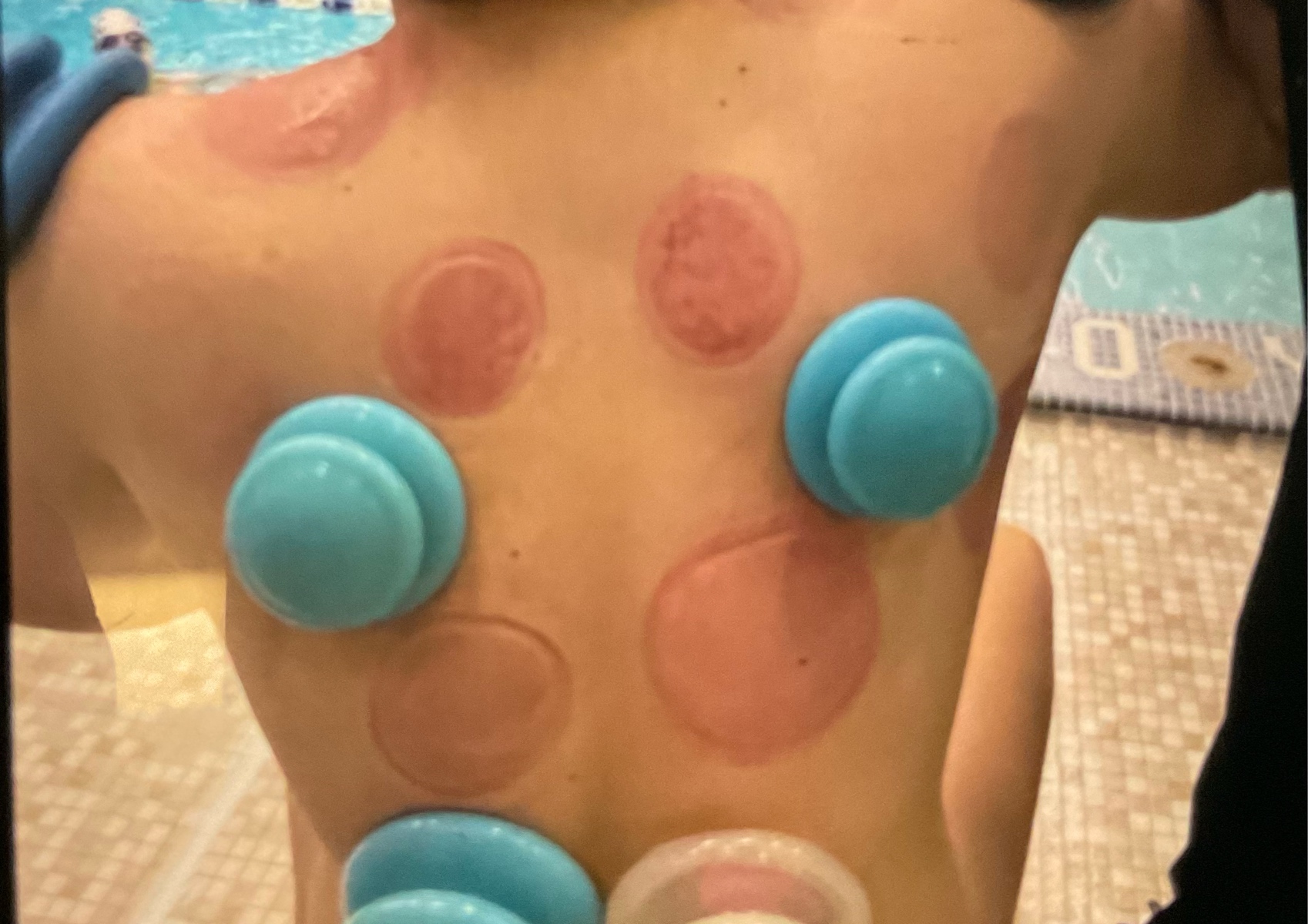 Cupping with deep tissue 