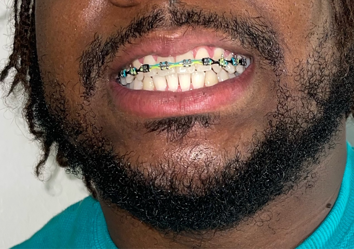 Cosmetic braces( ONE ROW ) upper or lower 