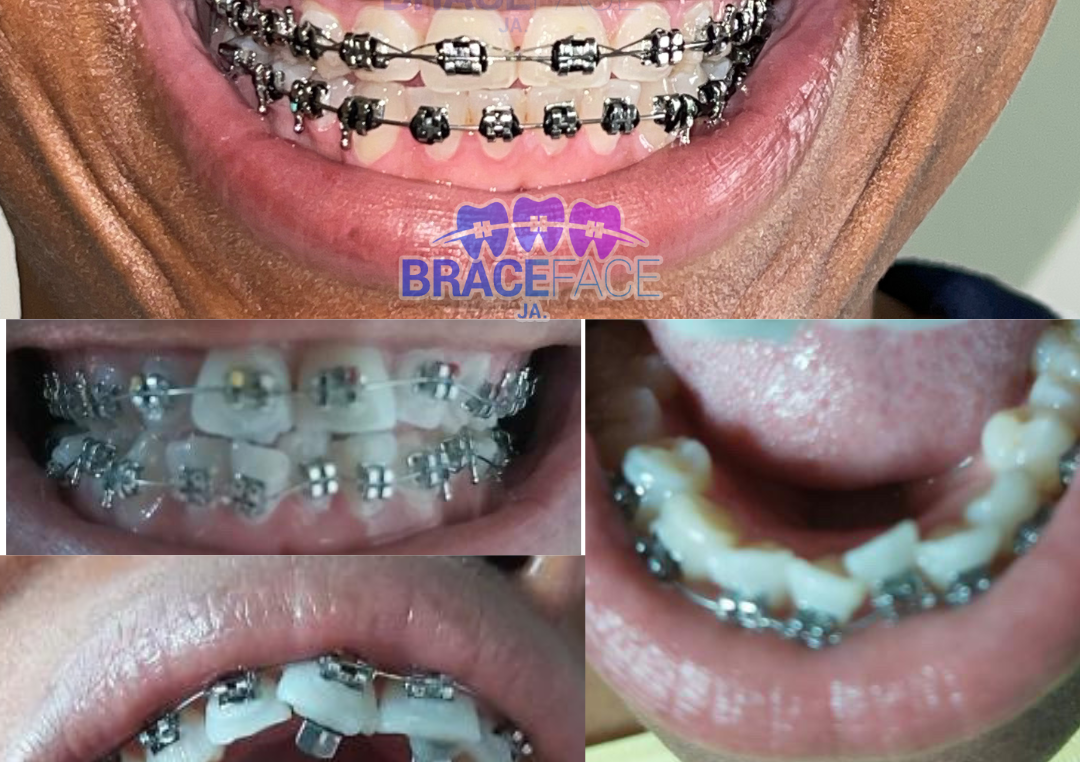 (Both Rows) Authentic Installation 