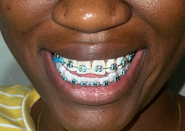 Teeth whitening (Kit)