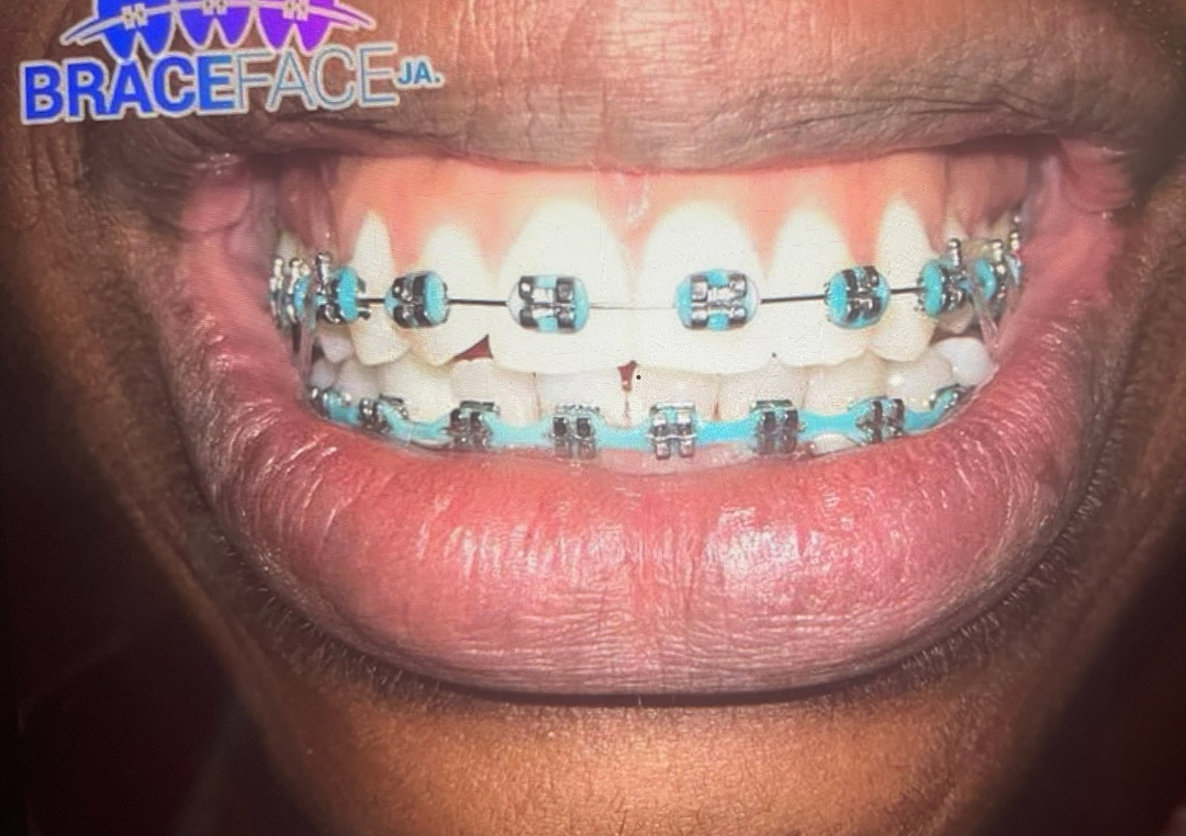 Installing Cosmetics (both rows)