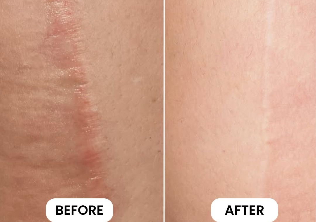 Scar & adhesion release therapy 