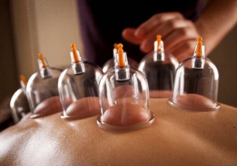 Cupping 
