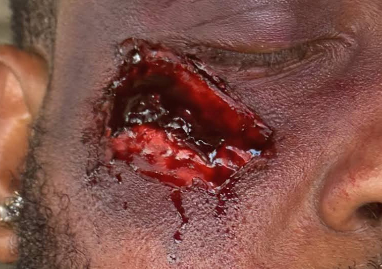 Small Scar - Up to 2 inches 