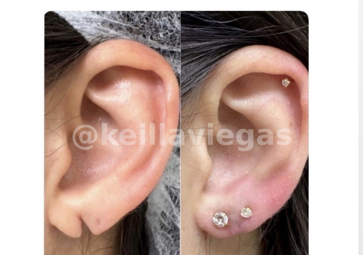 UNCUT lobuloplasty in both ears