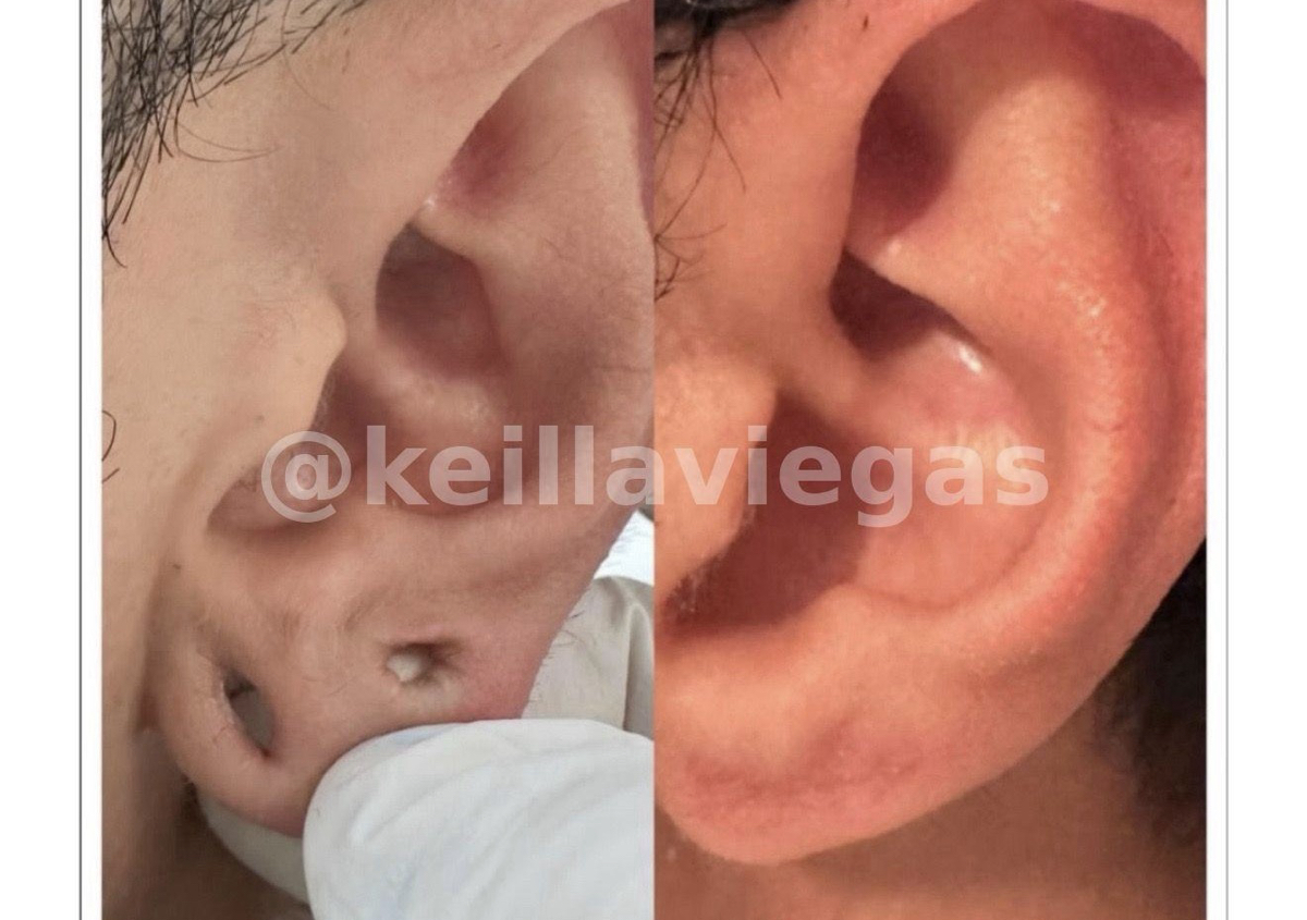 UNCUT lobuloplasty ONE ear