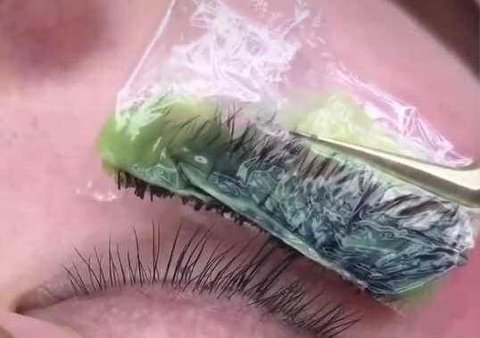Removal  of  lashes