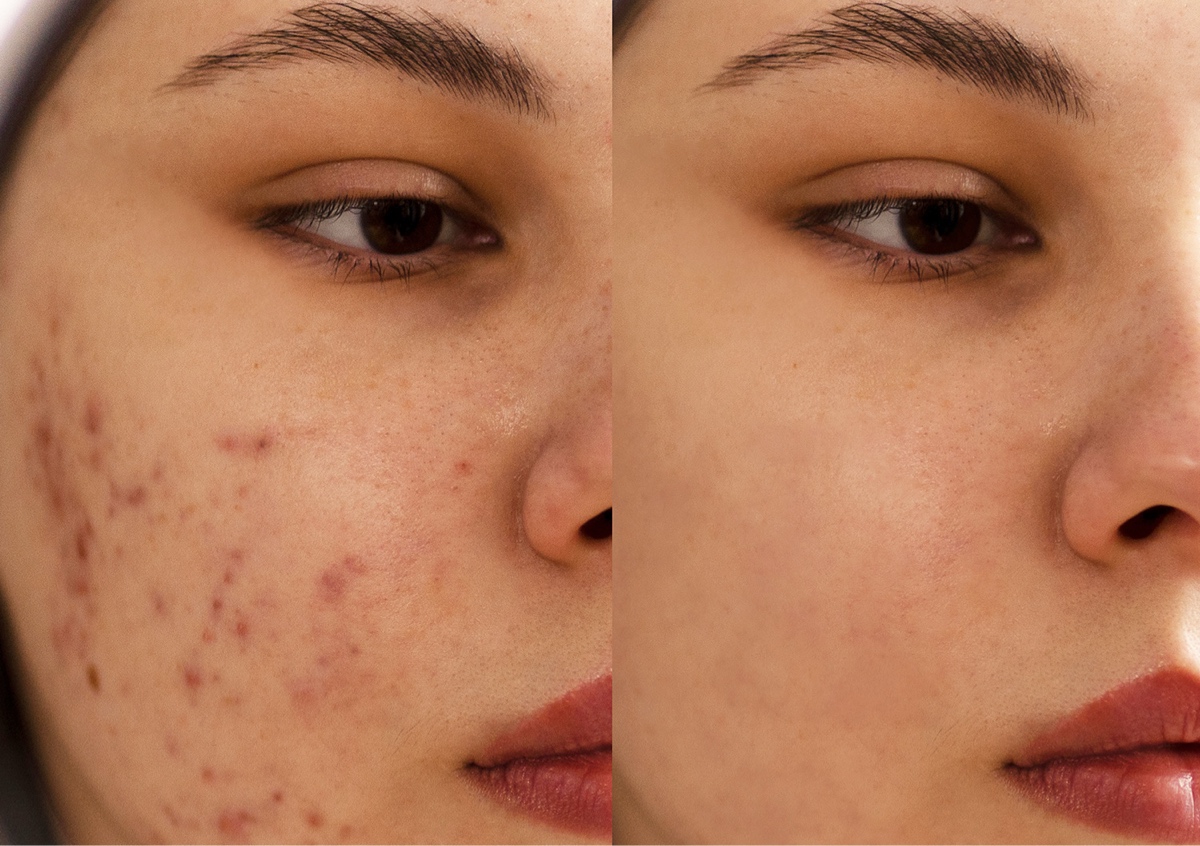 Facial Acne treatment 