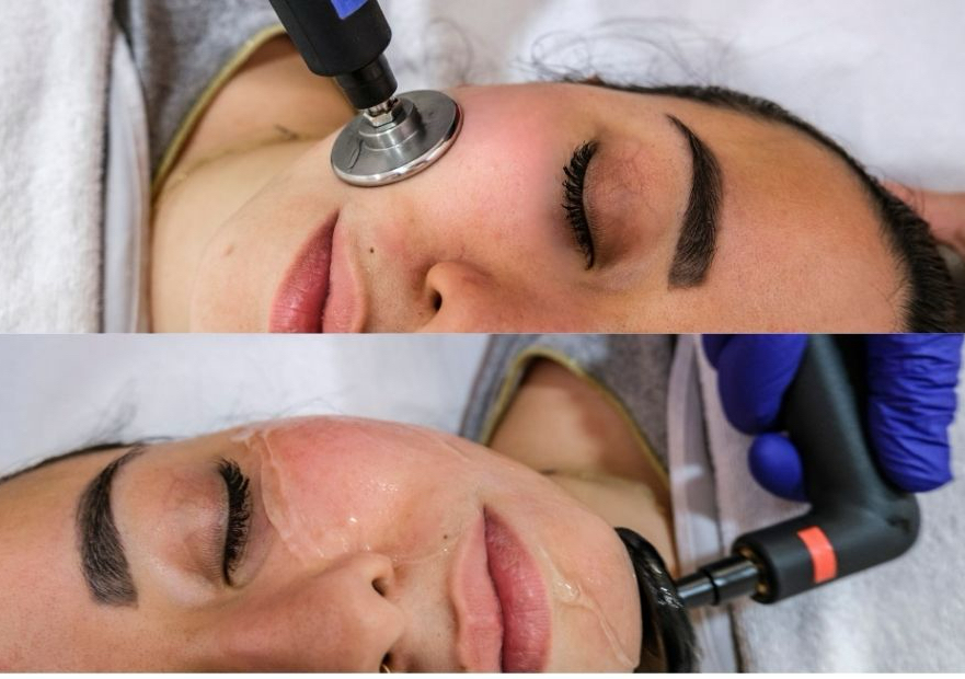 Lifting Facial con Ultra Radiofrecuencia 