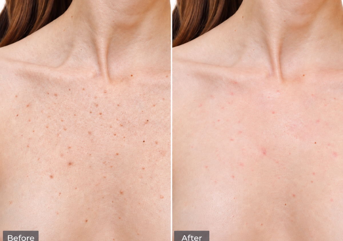 Deep Cleansing Décolleté Treatment