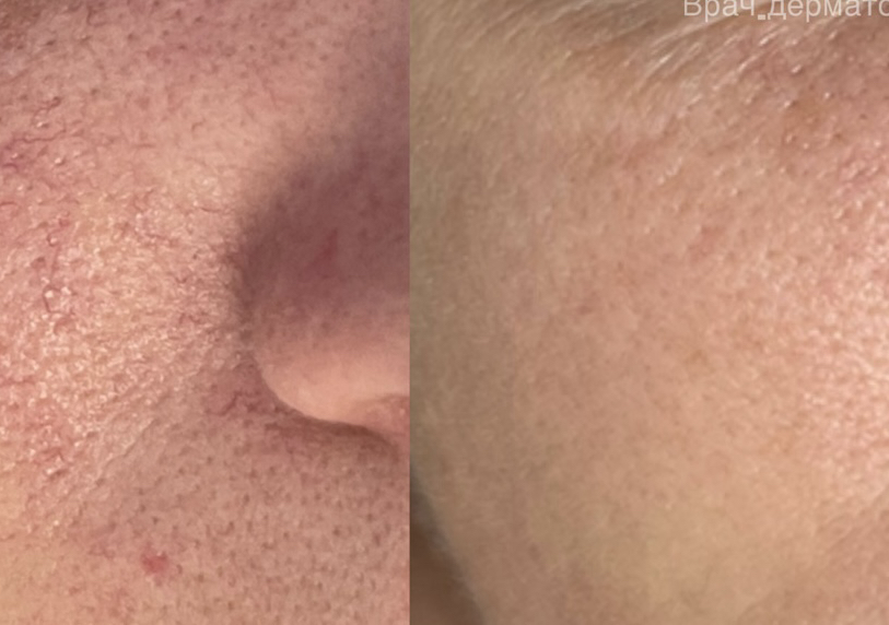 AZELAC Chemical PEEL