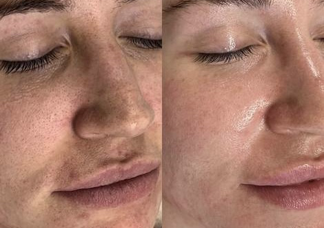 Lactic Acid Chemical Peeling