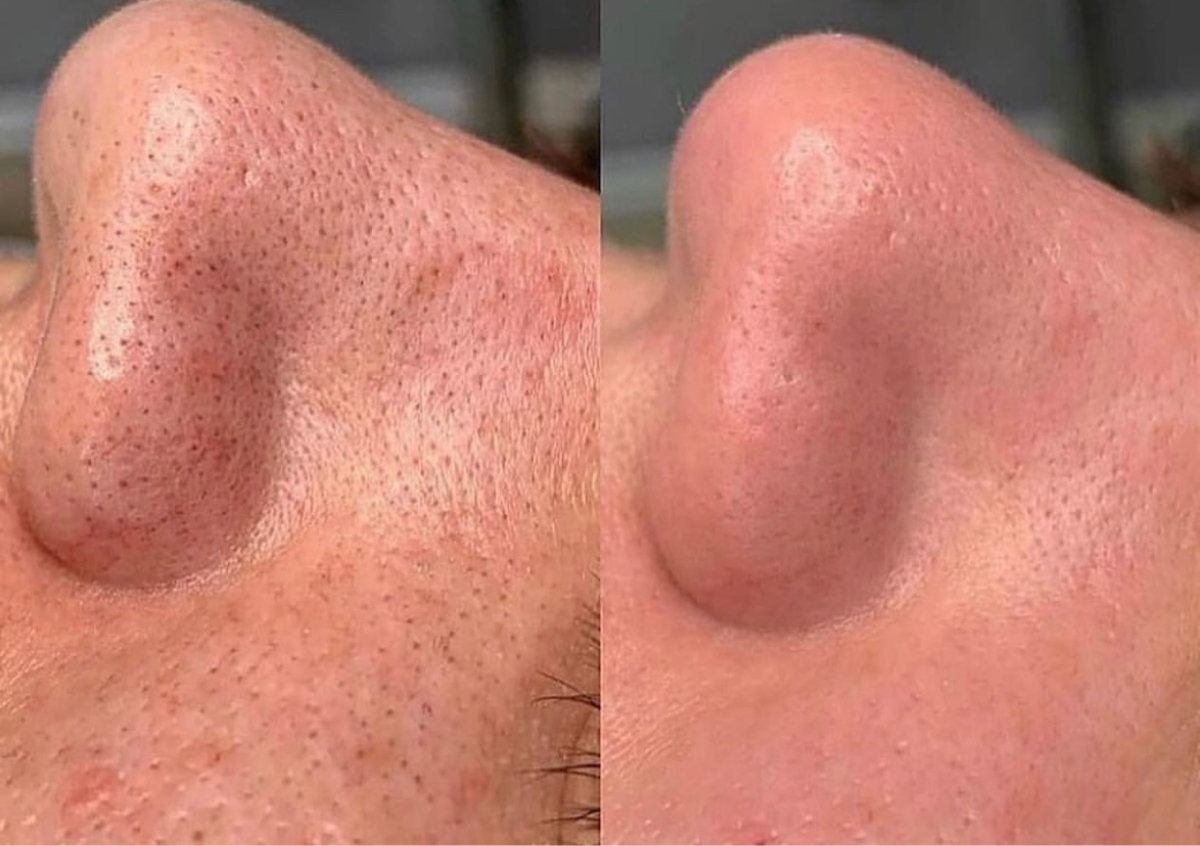 Deep Cleansing Facial