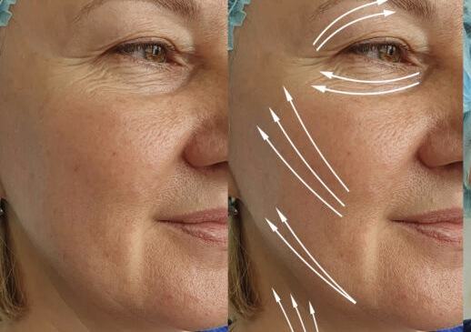 DMAE lifting Treatment 55+