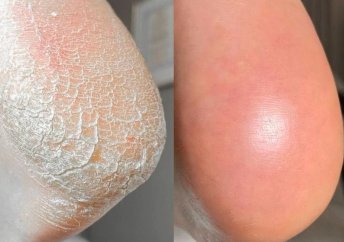 Trattamento per piedi secchi,con ragadi e callosità