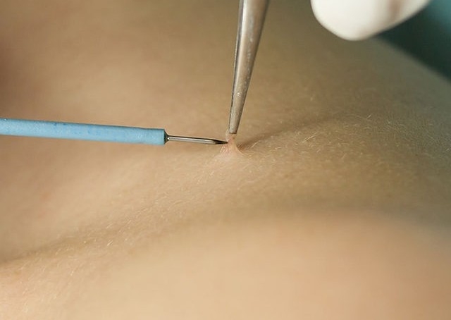 Remova l -  1 - 5 Skin Tags