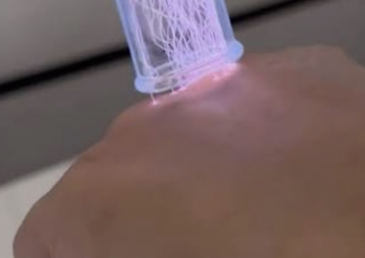 Hyperplasma Shower Eczema Treatment - Small Area