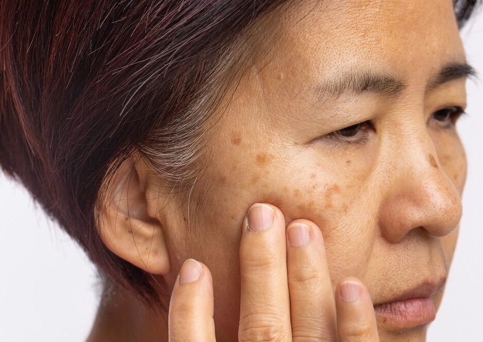 Removal - Pigmentation Spot (3 areas per appointment)