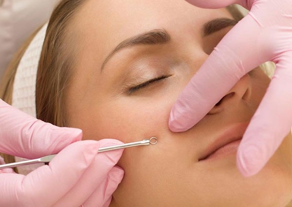 Removal - Blackhead Extraction 1 Hour