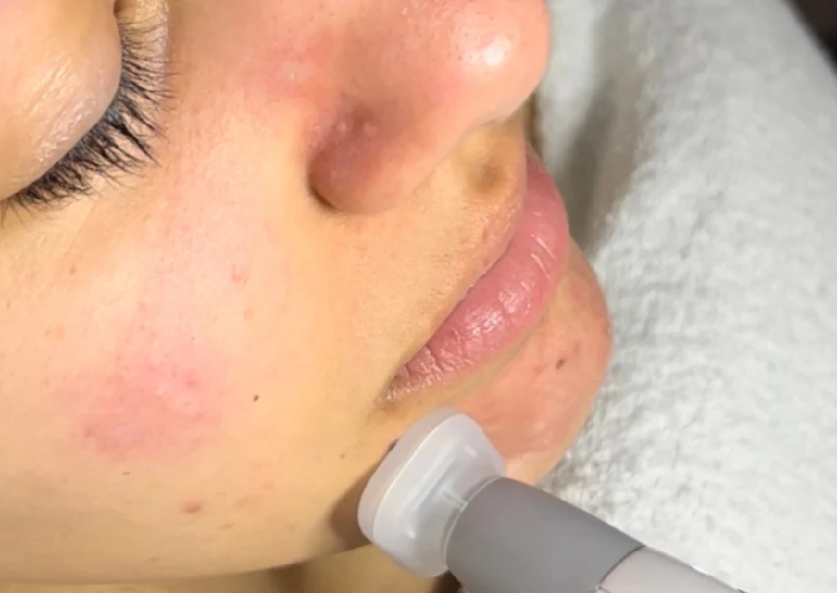 Cool Plasma - Scar Tissue