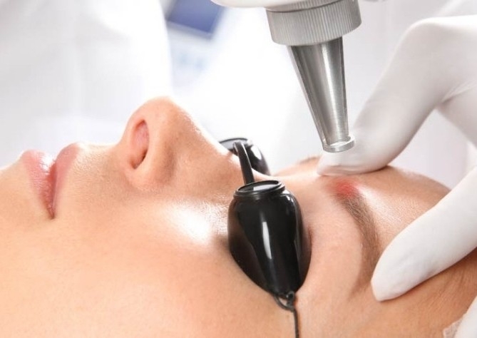 Removal - SPMU Eyebrow Tattoo Session