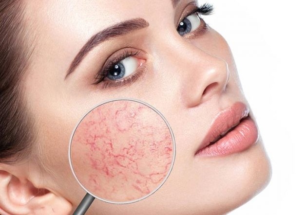 Removal - Follow Up Thread Vein