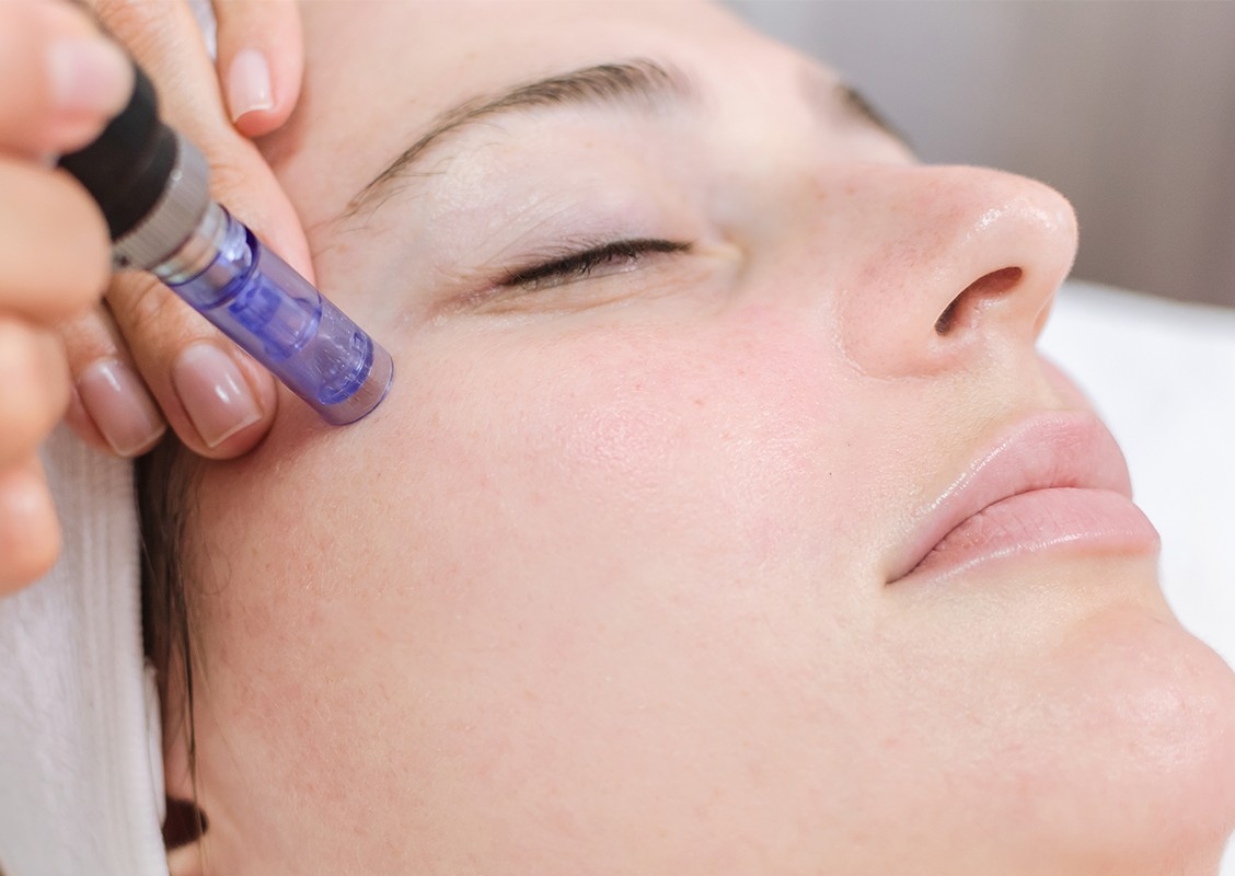 Microneedling Hyaulronic Acid + Collagen - Fine Lines & Moisture Boost