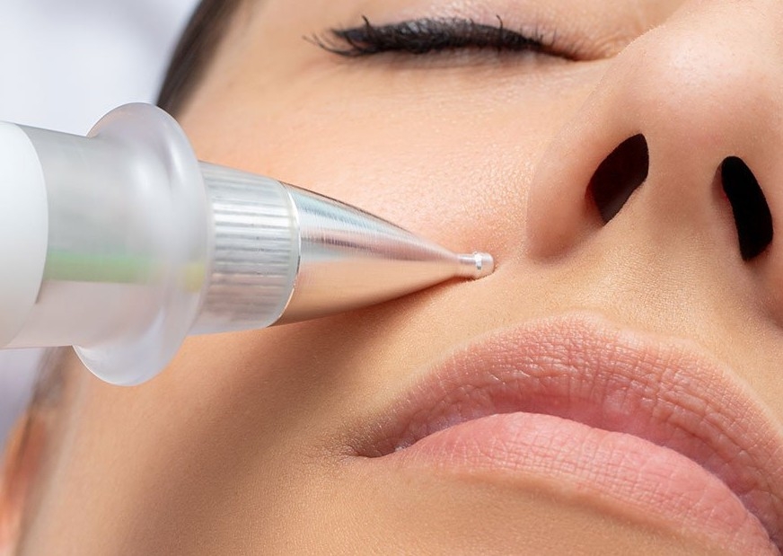 Hot Plasma - Smoker, Nasolabial & Marionette Lines